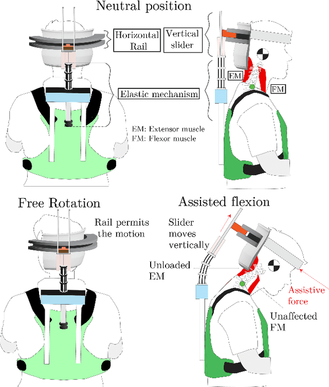 Figure 1 for A Neck Orthosis with Multi-Directional Variable Stiffness for Persons with Dropped Head Syndrome