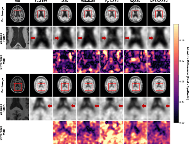 Figure 3 for MCR-VQGAN: A Scalable and Cost-Effective Tau PET Synthesis Approach for Alzheimer's Disease Imaging