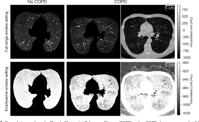 Figure 3 for Optimizing Convolutional Neural Networks for Chronic Obstructive Pulmonary Disease Detection in Clinical Computed Tomography Imaging