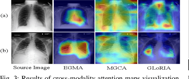 Figure 3 for Eye-gaze Guided Multi-modal Alignment Framework for Radiology