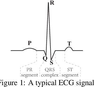 Figure 1 for Interpretable Tsetlin Machine-based Premature Ventricular Contraction Identification