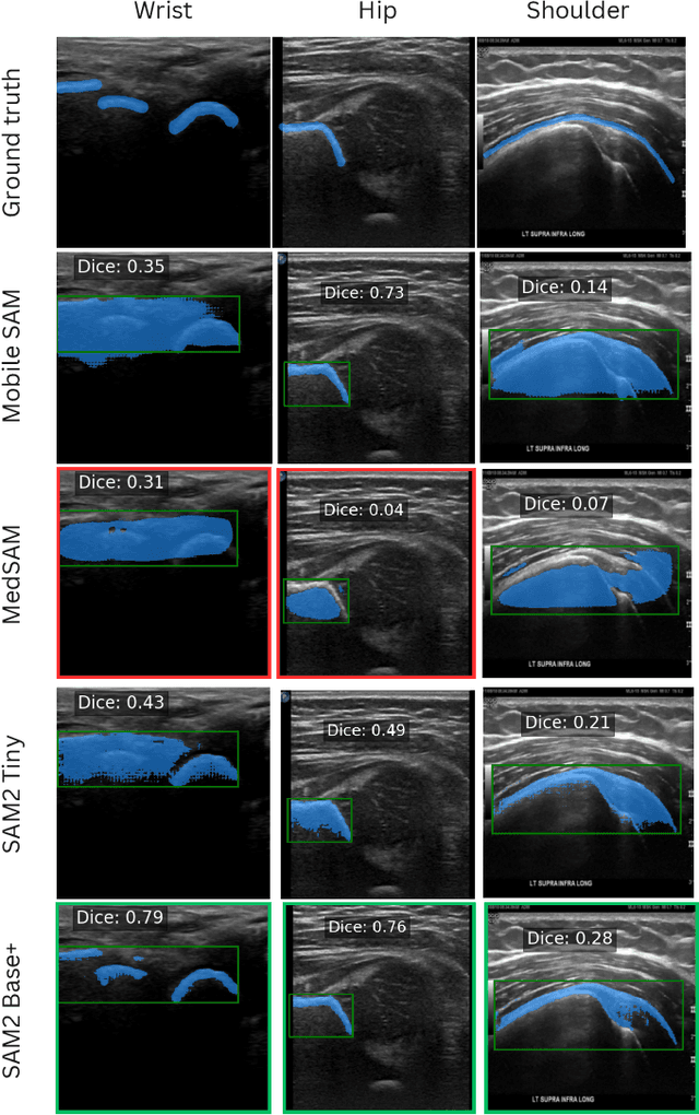 Figure 3 for Sam2Rad: A Segmentation Model for Medical Images with Learnable Prompts