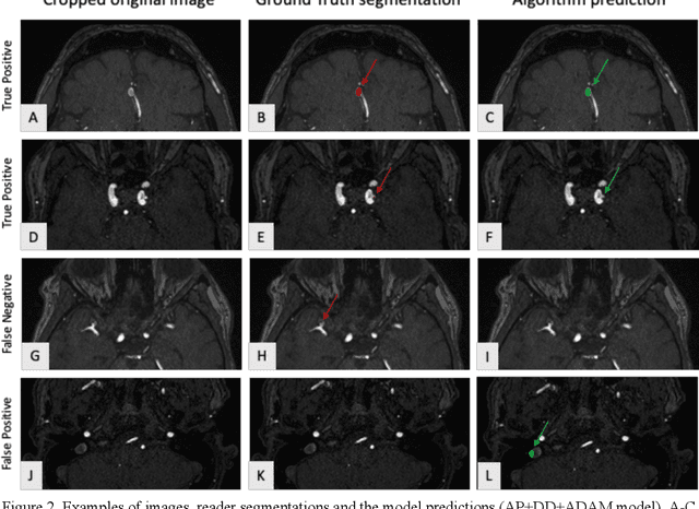 Figure 4 for Multi-centric AI Model for Unruptured Intracranial Aneurysm Detection and Volumetric Segmentation in 3D TOF-MRI