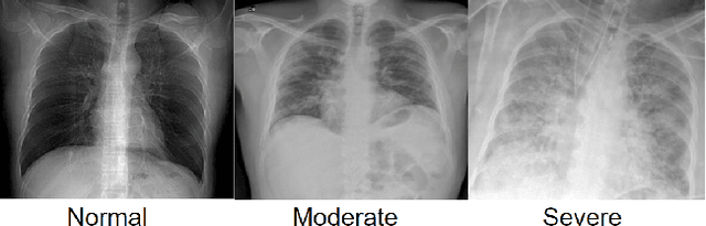 Figure 1 for Diagnosing COVID-19 Severity from Chest X-Ray Images Using ViT and CNN Architectures