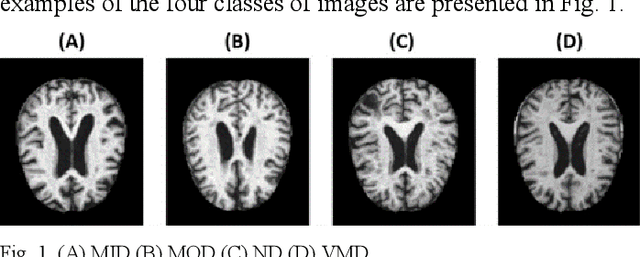 Figure 1 for Early diagnosis of Alzheimer's disease from MRI images with deep learning model