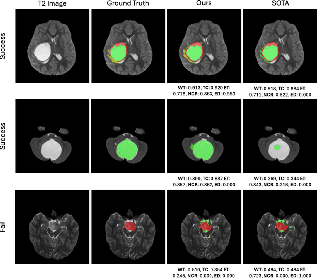 Figure 3 for A New Logic For Pediatric Brain Tumor Segmentation