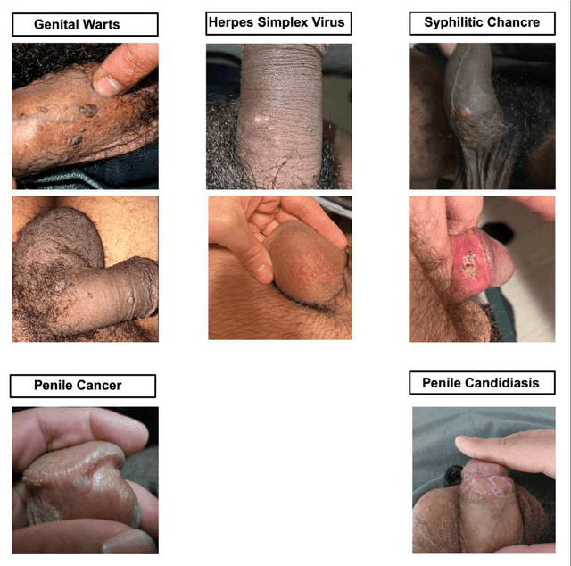 Figure 4 for The Development and Performance of a Machine Learning Based Mobile Platform for Visually Determining the Etiology of Penile Pathology