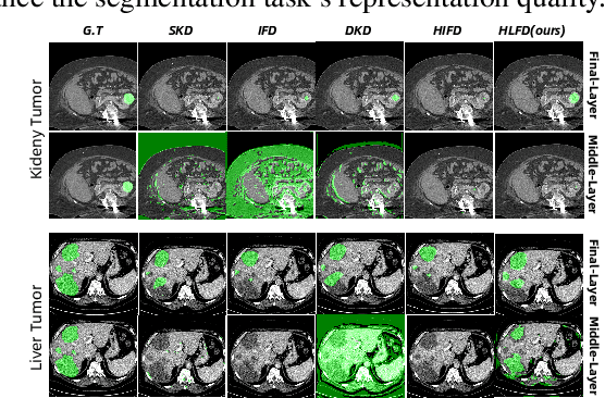 Figure 4 for Rethinking Intermediate Layers design in Knowledge Distillation for Kidney and Liver Tumor Segmentation