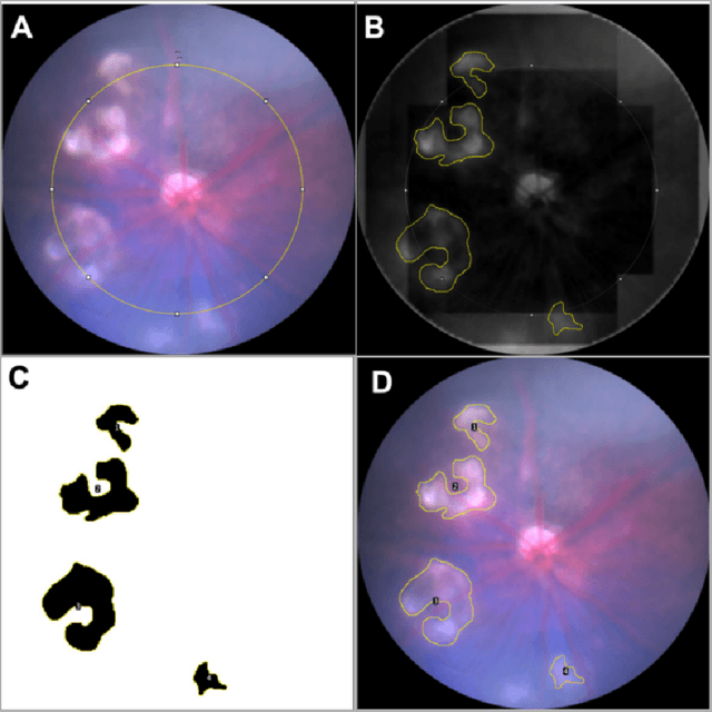 Figure 3 for Machine Learning-Based Prediction of Key Genes Correlated to the Subretinal Lesion Severity in a Mouse Model of Age-Related Macular Degeneration