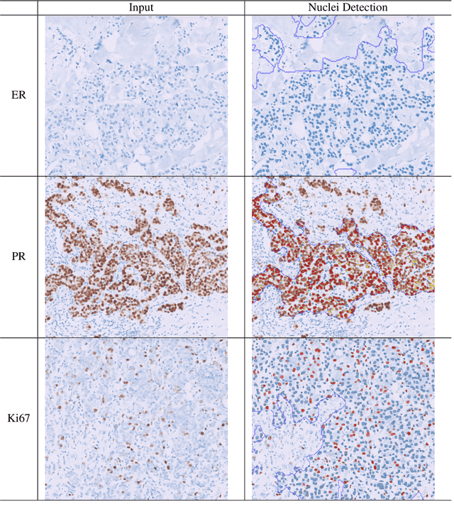 Figure 3 for Development and Validation of Fully Automatic Deep Learning-Based Algorithms for Immunohistochemistry Reporting of Invasive Breast Ductal Carcinoma