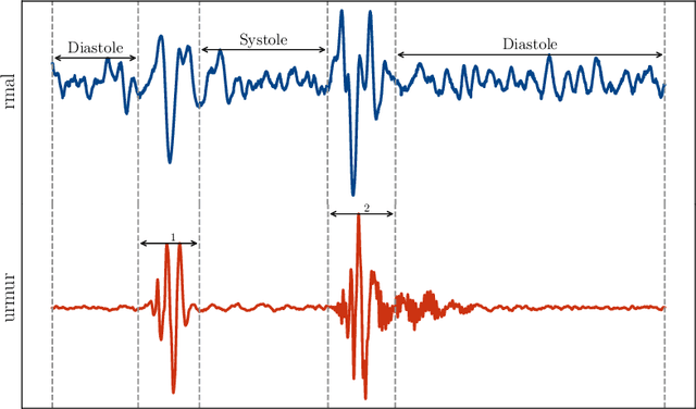 Figure 1 for FunnelNet: An End-to-End Deep Learning Framework to Monitor Digital Heart Murmur in Real-Time