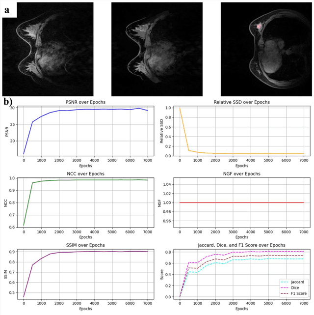 Figure 4 for Variational U-Net with Local Alignment for Joint Tumor Extraction and Registration (VALOR-Net) of Breast MRI Data Acquired at Two Different Field Strengths