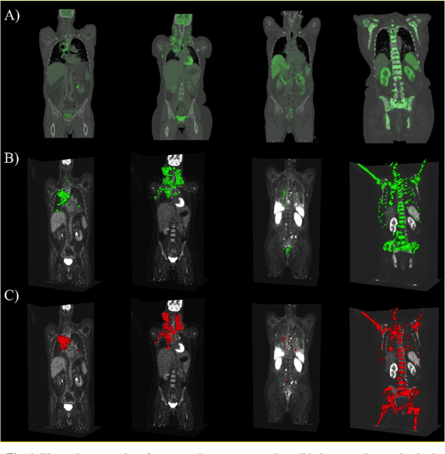 Figure 1 for Lesion Segmentation in Whole-Body Multi-Tracer PET-CT Images; a Contribution to AutoPET 2024 Challenge