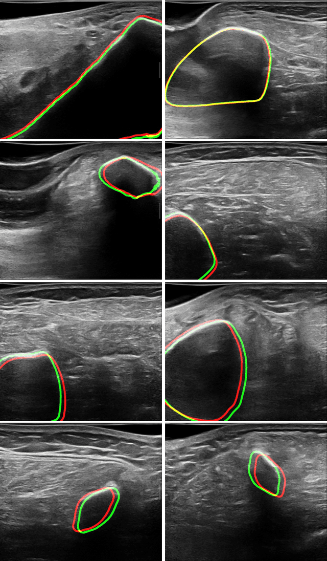 Figure 4 for UltraBones100k: An Ultrasound Image Dataset with CT-Derived Labels for Lower Extremity Long Bone Surface Segmentation