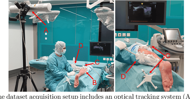 Figure 1 for UltraBones100k: An Ultrasound Image Dataset with CT-Derived Labels for Lower Extremity Long Bone Surface Segmentation