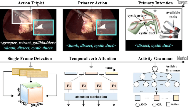 Figure 1 for Leveraging Surgical Activity Grammar for Primary Intention Prediction in Laparoscopy Procedures