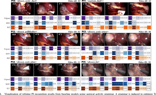 Figure 4 for Leveraging Surgical Activity Grammar for Primary Intention Prediction in Laparoscopy Procedures