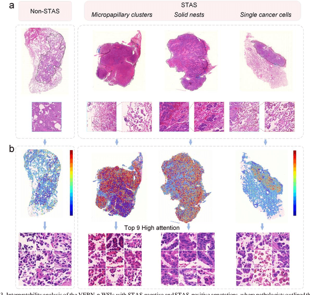 Figure 4 for Feature-interactive Siamese graph encoder-based image analysis to predict STAS from histopathology images in lung cancer