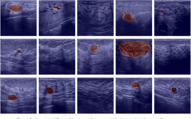 Figure 3 for Multi-Attention Integrated Deep Learning Frameworks for Enhanced Breast Cancer Segmentation and Identification