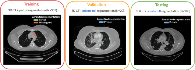 Figure 1 for LNQ 2023 challenge: Benchmark of weakly-supervised techniques for mediastinal lymph node quantification