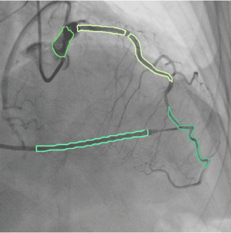 Figure 3 for MPSeg : Multi-Phase strategy for coronary artery Segmentation