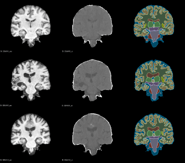 Figure 3 for MambaMorph: a Mamba-based Backbone with Contrastive Feature Learning for Deformable MR-CT Registration