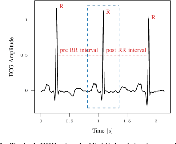 Figure 1 for A Noisy Beat is Worth 16 Words: a Tiny Transformer for Low-Power Arrhythmia Classification on Microcontrollers