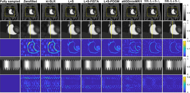 Figure 2 for Dynamic MRI reconstruction using low-rank plus sparse decomposition with smoothness regularization