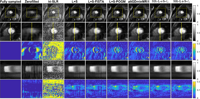 Figure 3 for Dynamic MRI reconstruction using low-rank plus sparse decomposition with smoothness regularization