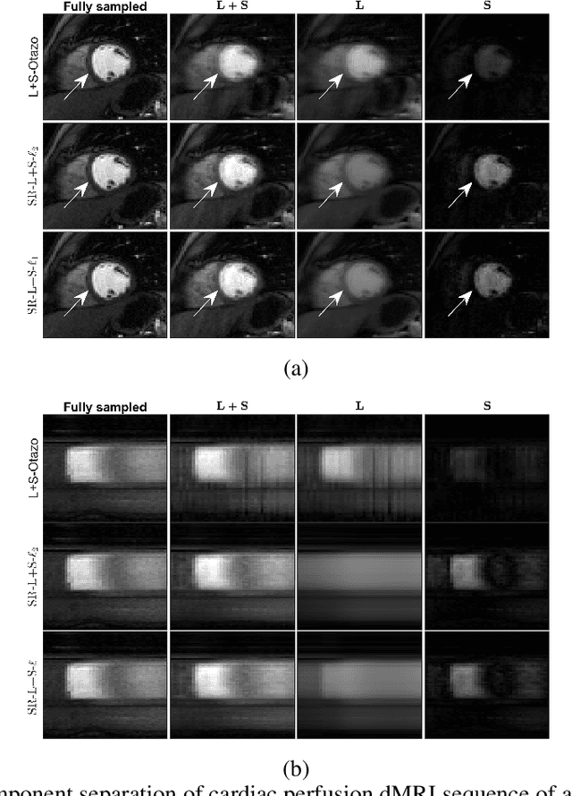 Figure 4 for Dynamic MRI reconstruction using low-rank plus sparse decomposition with smoothness regularization