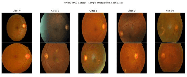 Figure 3 for A Novel Adaptive Hybrid Focal-Entropy Loss for Enhancing Diabetic Retinopathy Detection Using Convolutional Neural Networks