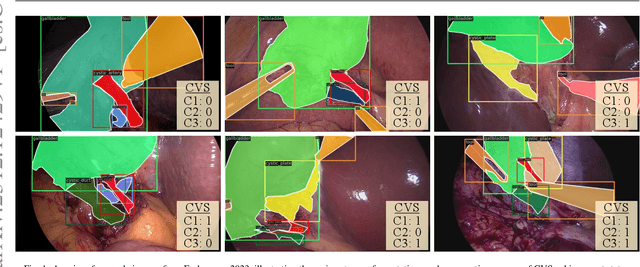 Figure 1 for The Endoscapes Dataset for Surgical Scene Segmentation, Object Detection, and Critical View of Safety Assessment: Official Splits and Benchmark