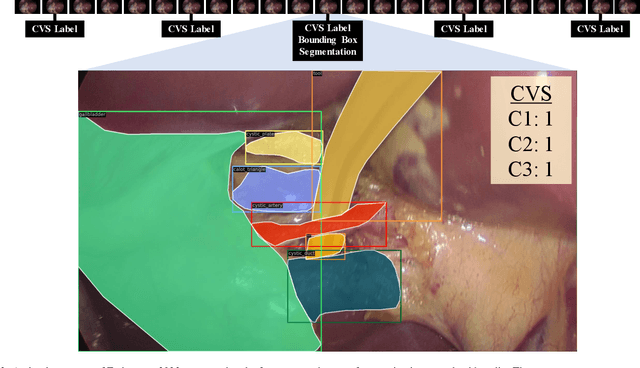 Figure 2 for The Endoscapes Dataset for Surgical Scene Segmentation, Object Detection, and Critical View of Safety Assessment: Official Splits and Benchmark