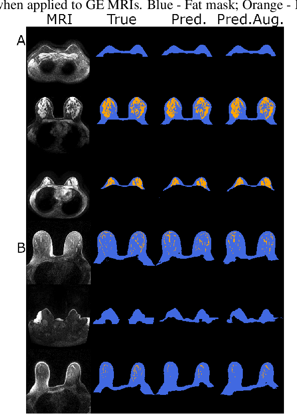 Figure 4 for Counterfactual MRI Data Augmentation using Conditional Denoising Diffusion Generative Models