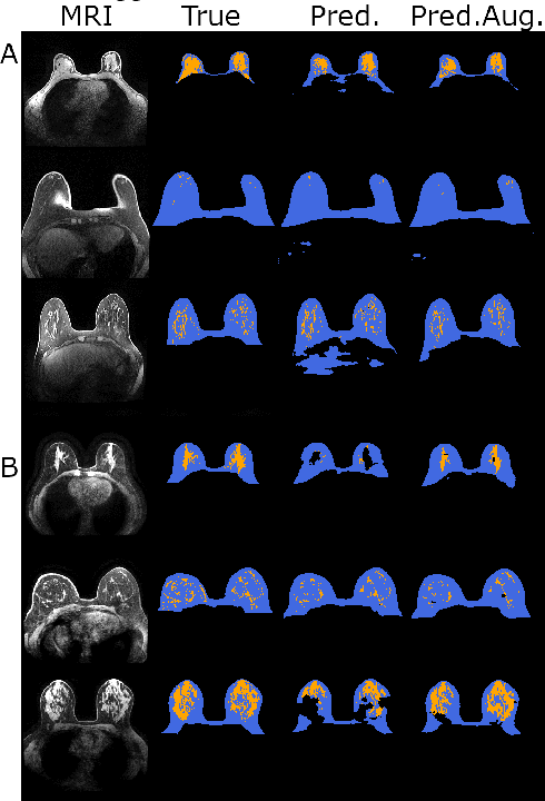 Figure 2 for Counterfactual MRI Data Augmentation using Conditional Denoising Diffusion Generative Models