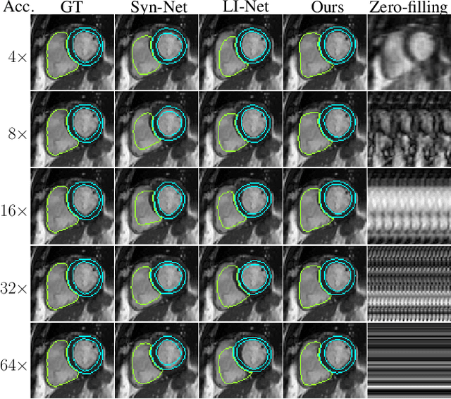 Figure 3 for Direct Cardiac Segmentation from Undersampled K-space Using Transformers