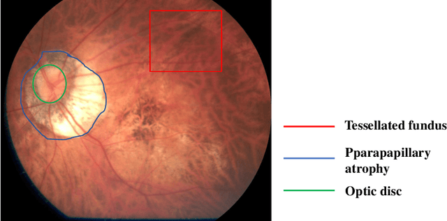 Figure 1 for Efficient Pyramid Channel Attention Network for Pathological Myopia Detection