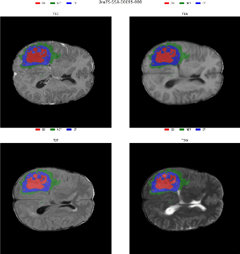 Figure 1 for Optimizing Brain Tumor Segmentation with MedNeXt: BraTS 2024 SSA and Pediatrics