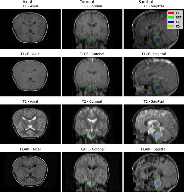 Figure 3 for Optimizing Brain Tumor Segmentation with MedNeXt: BraTS 2024 SSA and Pediatrics