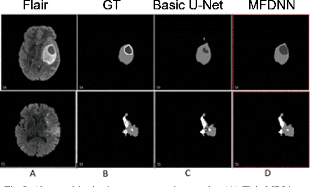 Figure 3 for Computational Modeling of Deep Multiresolution-Fractal Texture and Its Application to Abnormal Brain Tissue Segmentation