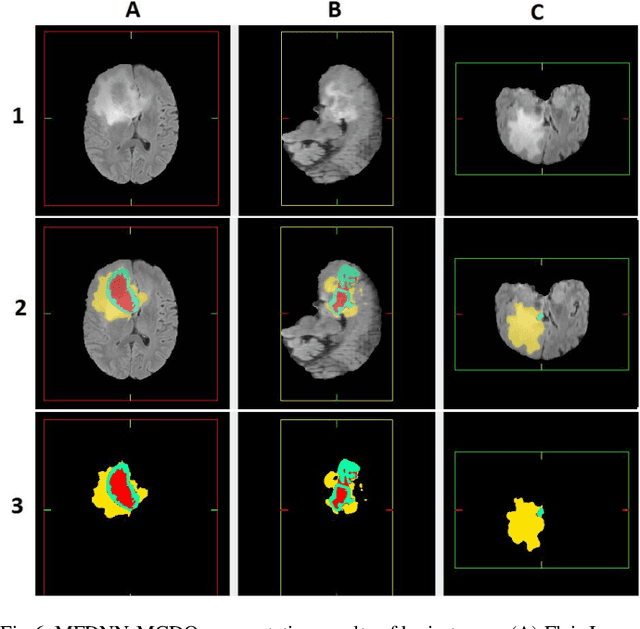 Figure 4 for Computational Modeling of Deep Multiresolution-Fractal Texture and Its Application to Abnormal Brain Tissue Segmentation