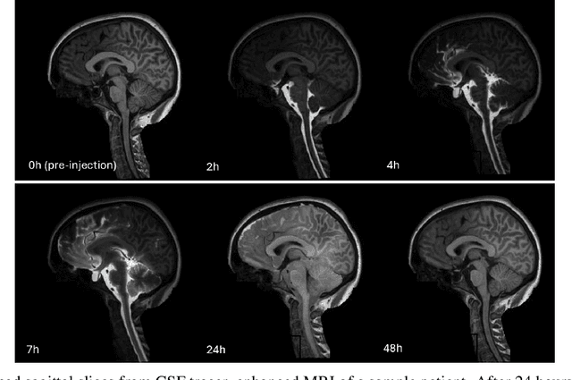 Figure 3 for U-net based prediction of cerebrospinal fluid distribution and ventricular reflux grading