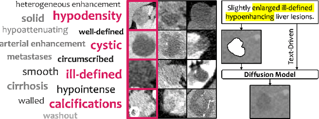 Figure 1 for Text-Driven Tumor Synthesis