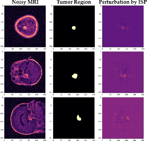 Figure 1 for Robust Influence-based Training Methods for Noisy Brain MRI