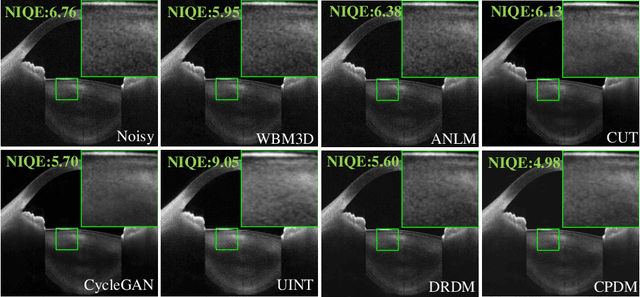 Figure 4 for Content-Preserving Diffusion Model for Unsupervised AS-OCT image Despeckling