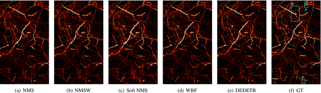 Figure 1 for Ensemble Learning for Microbubble Localization in Super-Resolution Ultrasound