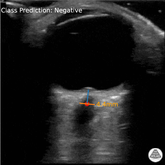 Figure 1 for Interpretable Models for Detecting and Monitoring Elevated Intracranial Pressure