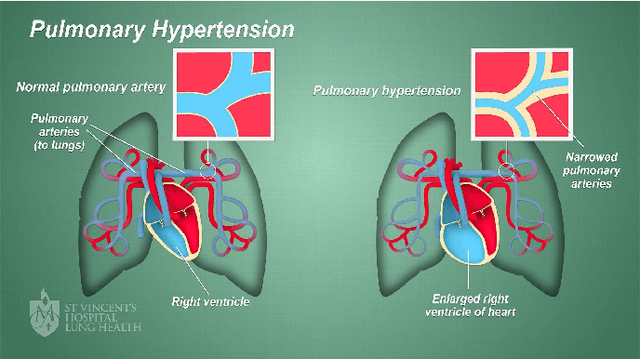 Figure 1 for Predicting Pulmonary Hypertension by Electrocardiograms Using Machine Learning