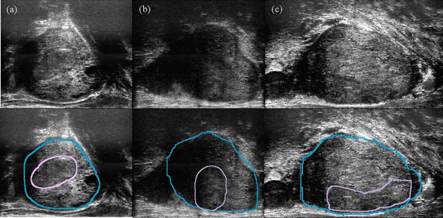 Figure 1 for Mask Enhanced Deeply Supervised Prostate Cancer Detection on B-mode Micro-Ultrasound