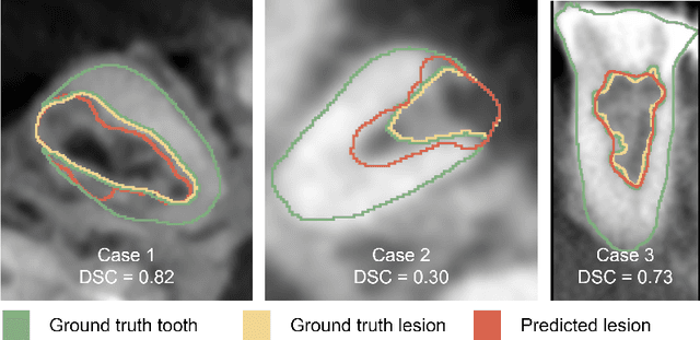 Figure 3 for Automated external cervical resorption segmentation in cone-beam CT using local texture features